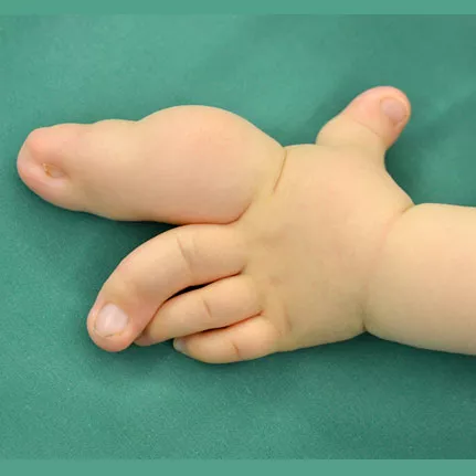 Handchirurgie, Makrodaktylie, vor der Operation