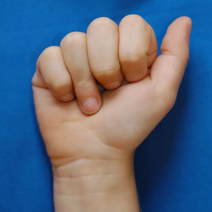 Handchirurgie, Sehnenverletzung, rechte Hand mit Sehnenverletzung am Ringfinger